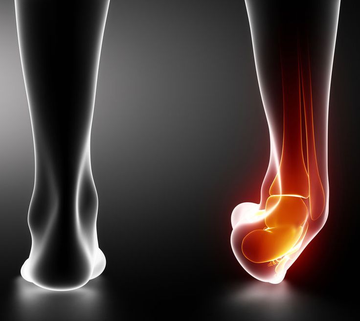 Ankle Sprain
